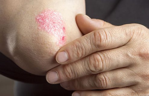 psoriasi farmaci rimedi